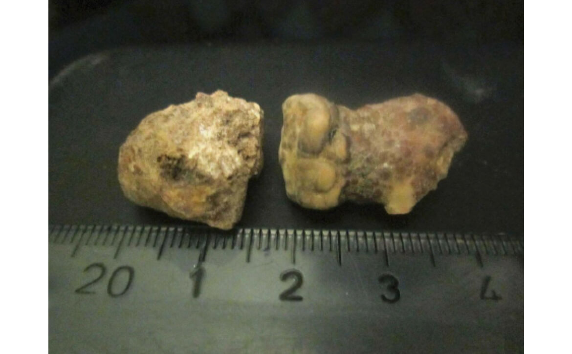 Meilleur urologue pédiatrique en Inde, urologie pédiatrique robotique